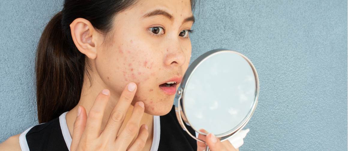 Is My Acne Caused by Anxiety?